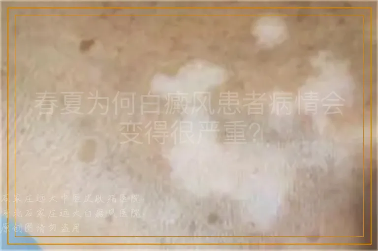 春夏为何白癜风患者病情会变得很严重？