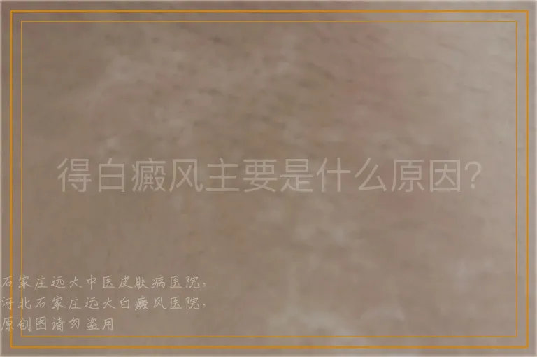 得白癜风主要是什么原因？