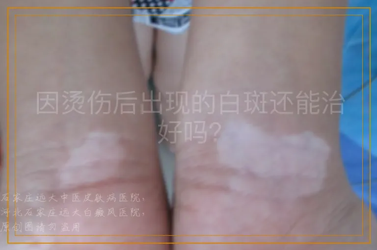 因烫伤后出现的白斑还能治好吗？