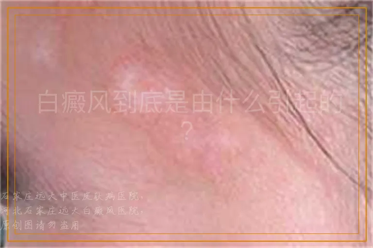 白癜风到底是由什么引起的？