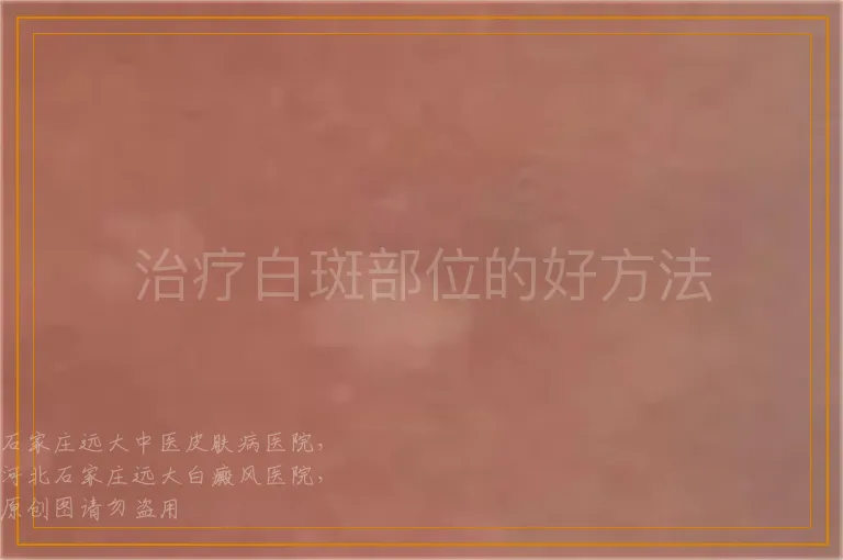 治疗白斑部位的好方法