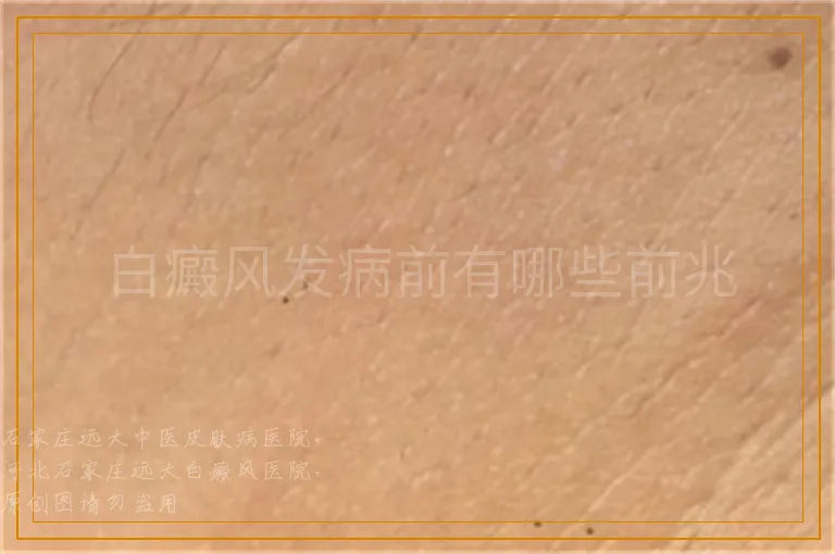 白癜风发病前有哪些前兆