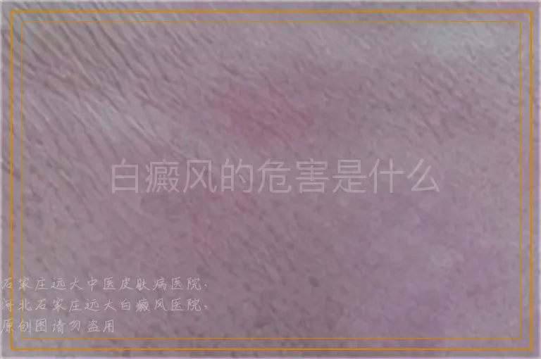 白癜风的危害是什么