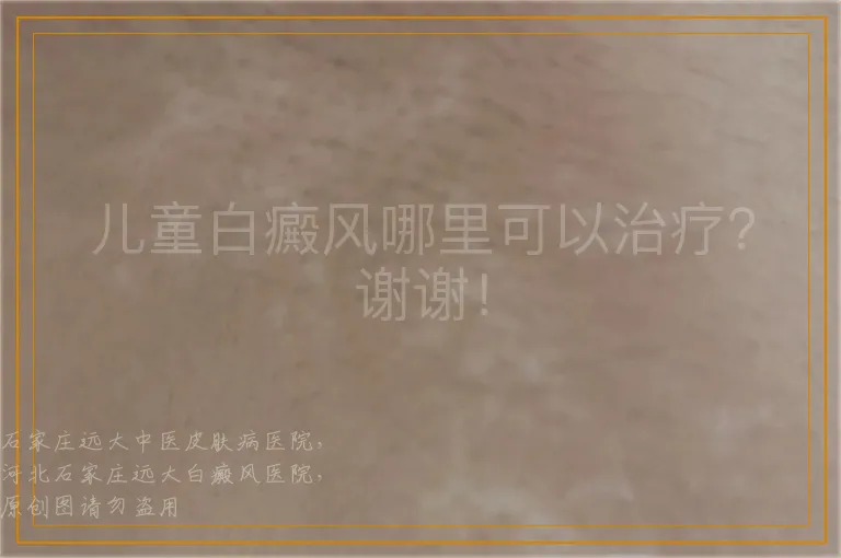 儿童白癜风哪里可以治疗？谢谢！