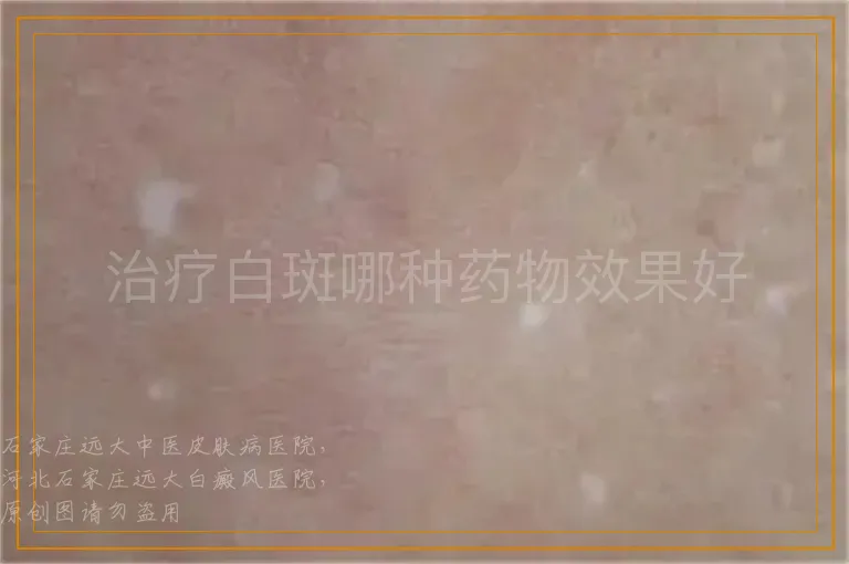 治疗白斑哪种药物效果好