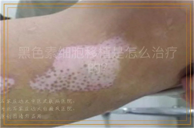 黑色素细胞移植是怎么治疗的？