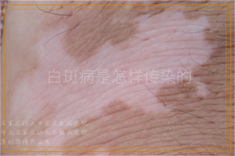白斑病是怎样传染的