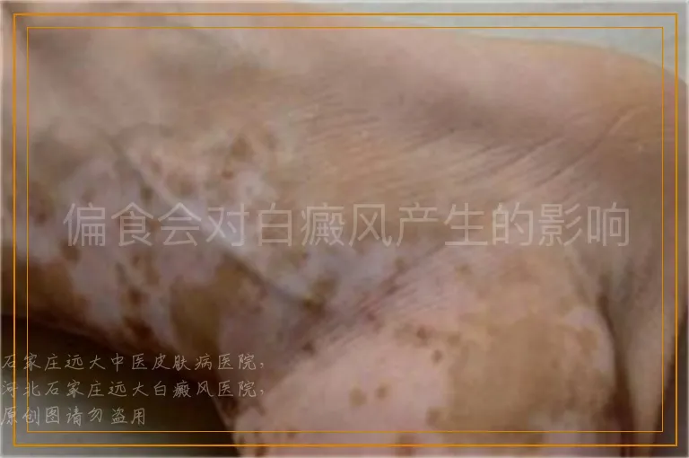 偏食会对白癜风产生的影响