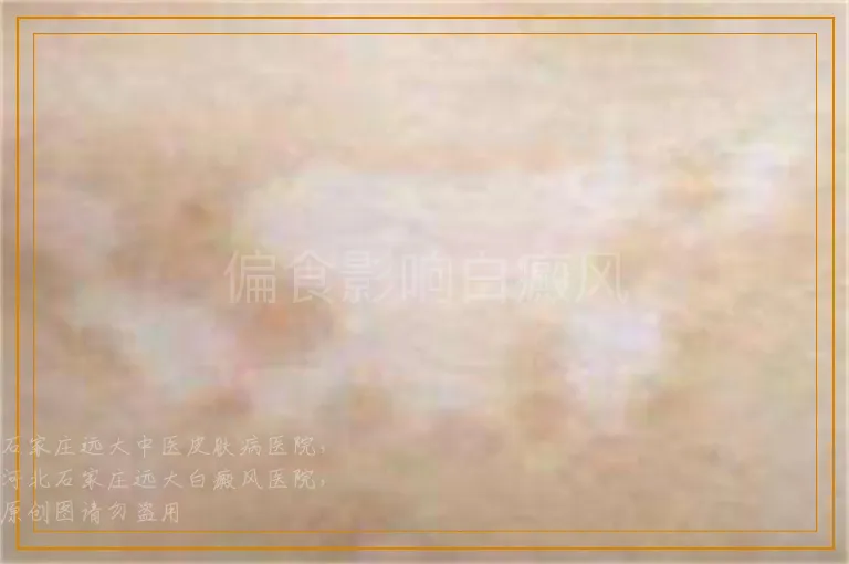 偏食影响白癜风