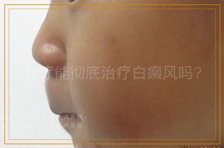 食疗能彻底治疗白癜风吗?