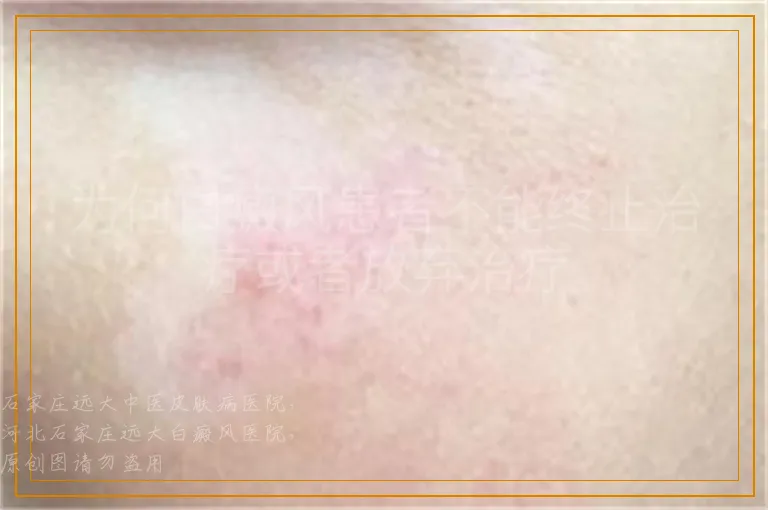 为何白癜风患者不能终止治疗或者放弃治疗