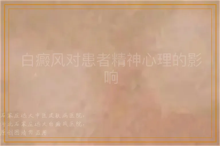 白癜风对患者精神心理的影响