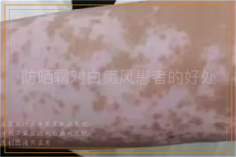 防晒霜对白癜风患者的好处