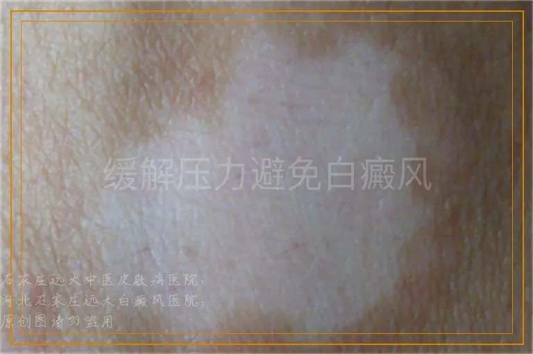 缓解压力避免白癜风