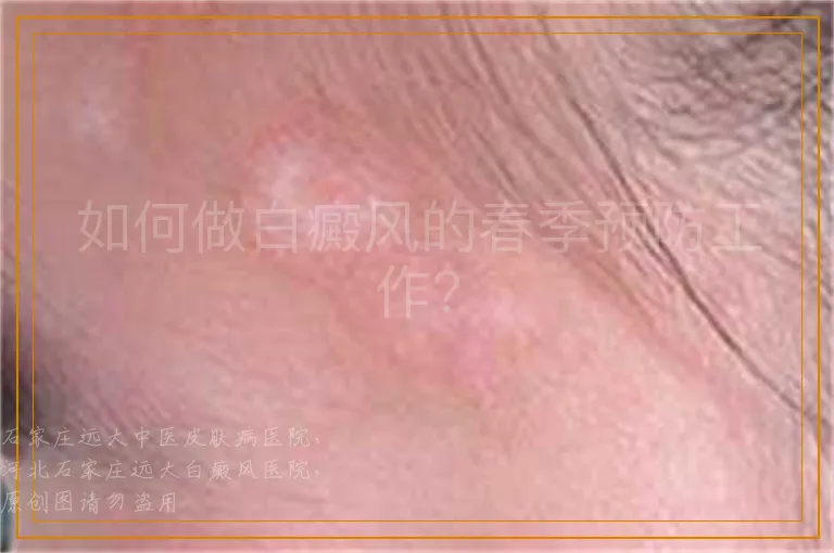 如何做白癜风的春季预防工作？