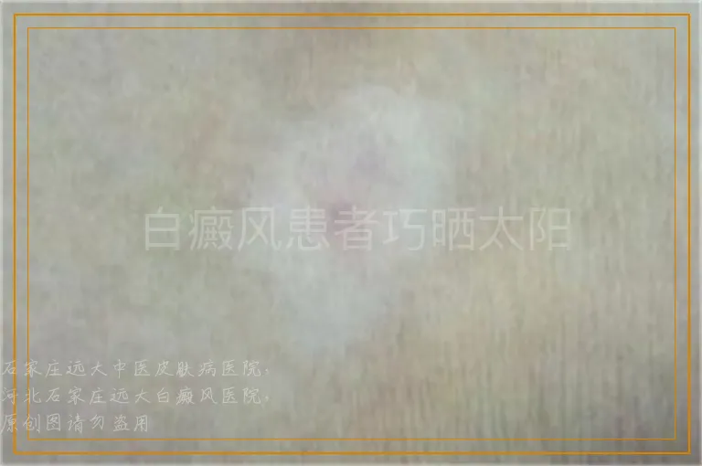 白癜风患者巧晒太阳