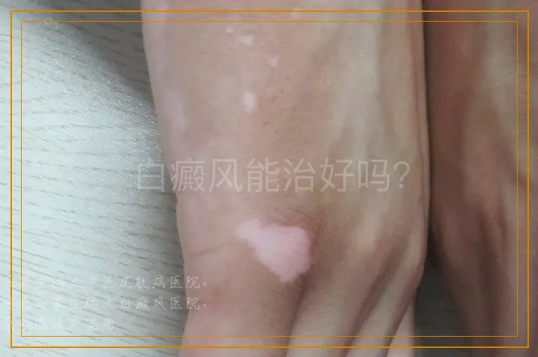 白癜风能治好吗？