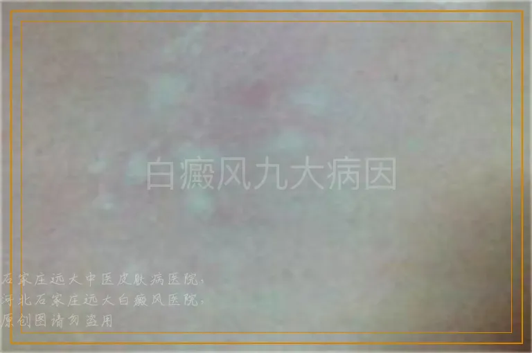 白癜风九大病因