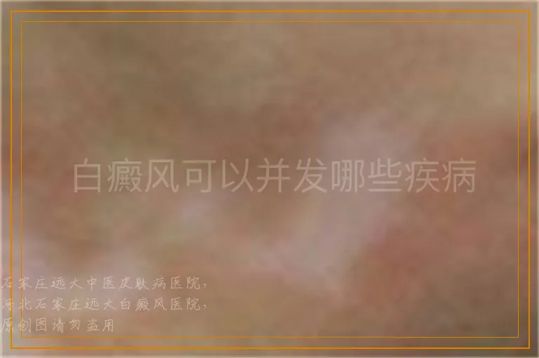 白癜风可以并发哪些疾病