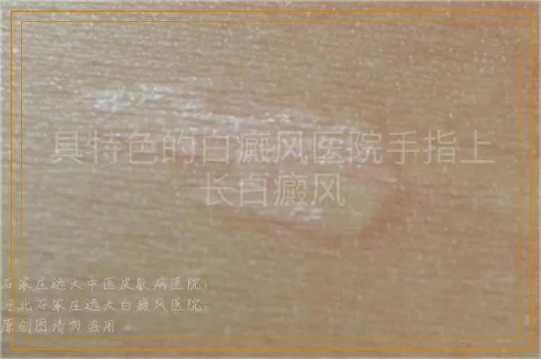 具特色的白癜风医院手指上长白癜风