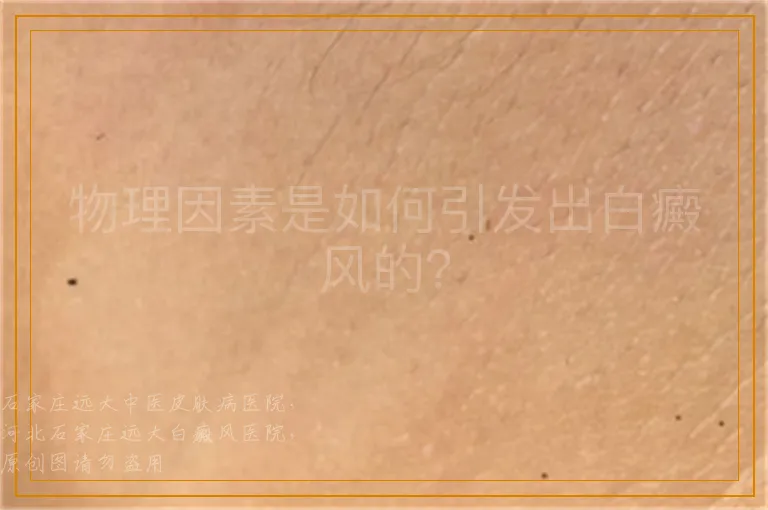 物理因素是如何引发出白癜风的？
