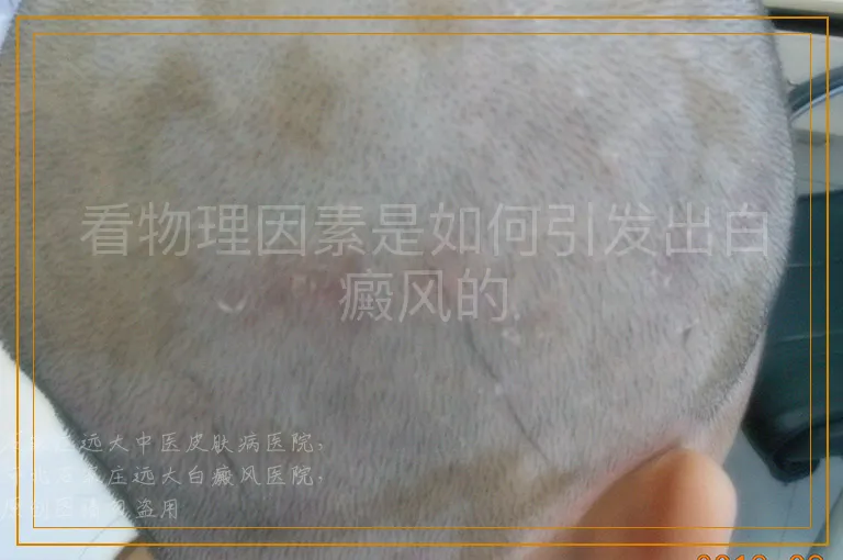 看物理因素是如何引发出白癜风的
