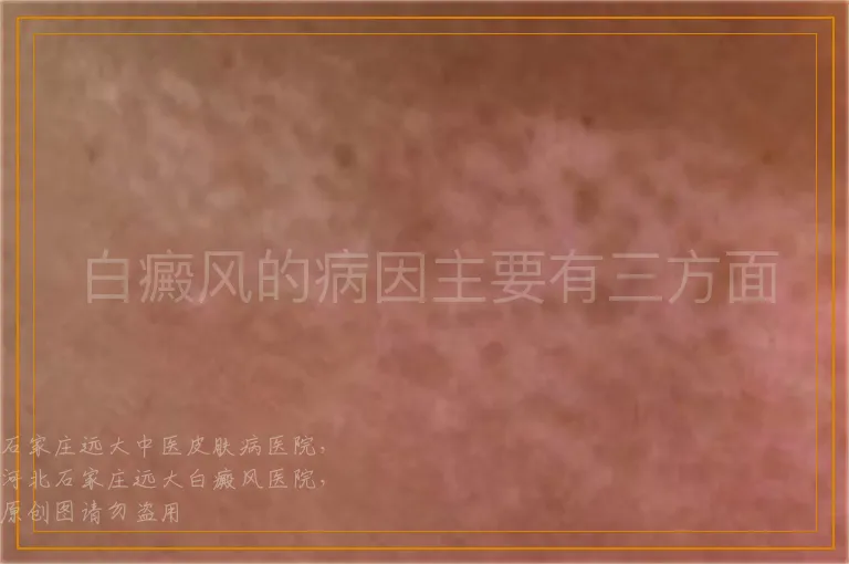 白癜风的病因主要有三方面