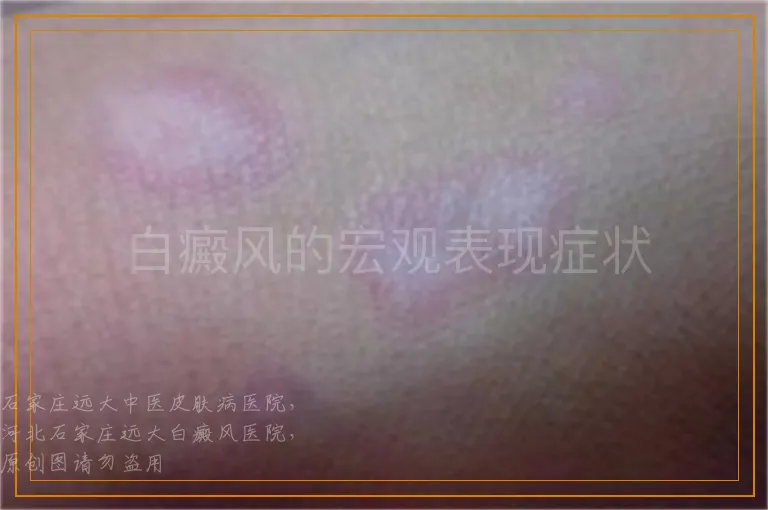 白癜风的宏观表现症状