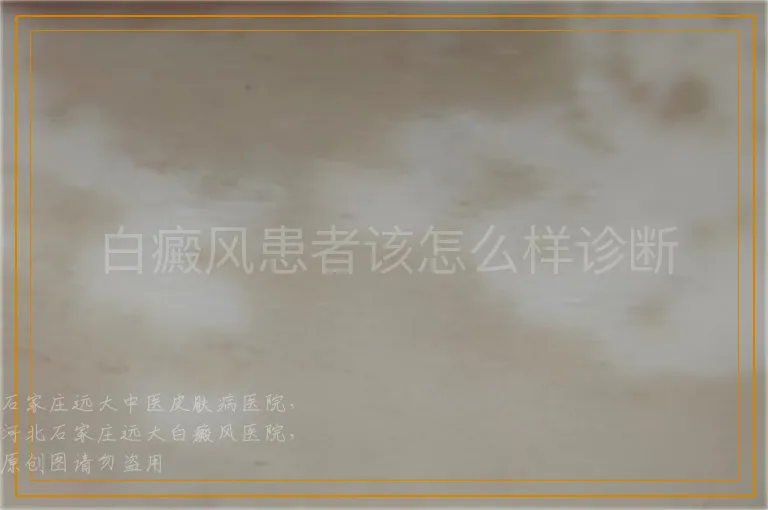 白癜风患者该怎么样诊断