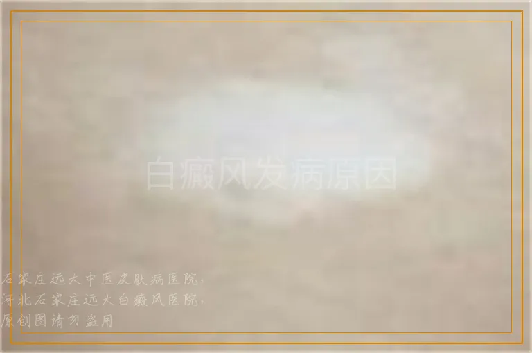 白癜风发病原因