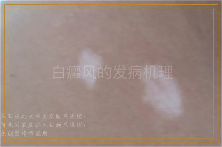 白癜风的发病机理
