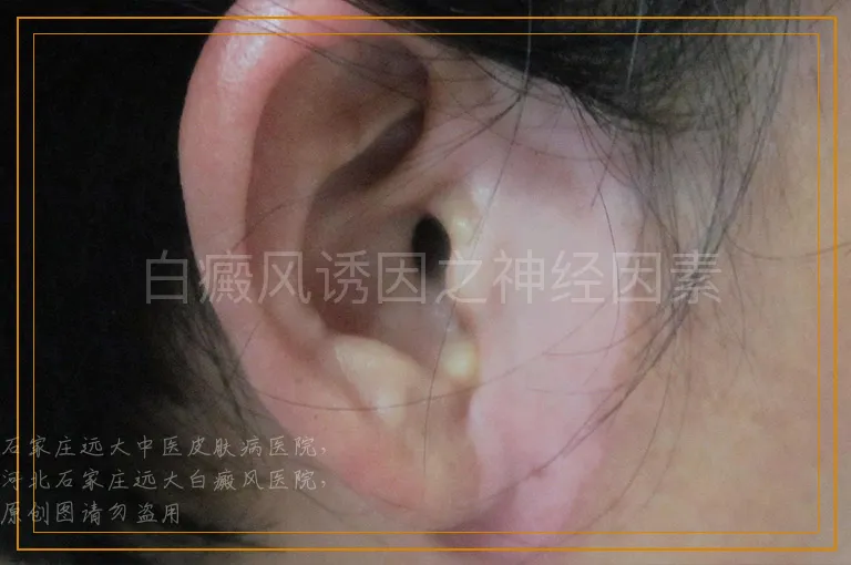 白癜风诱因之神经因素