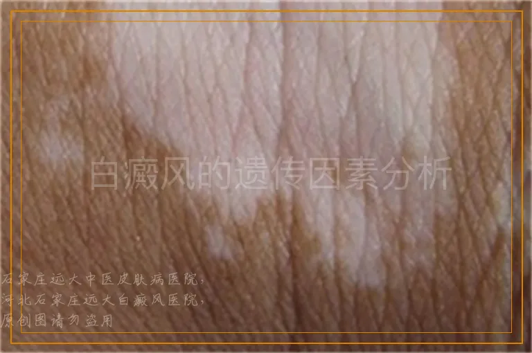 白癜风的遗传因素分析