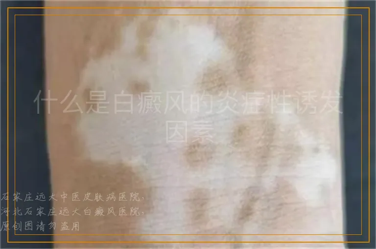 什么是白癜风的炎症性诱发因素
