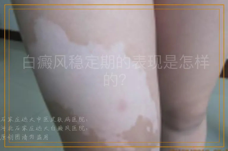 白癜风稳定期的表现是怎样的？