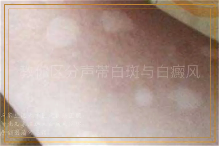 教你区分声带白斑与白癜风