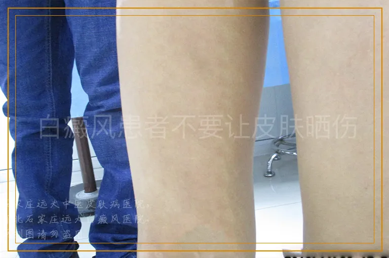 白癜风患者不要让皮肤晒伤
