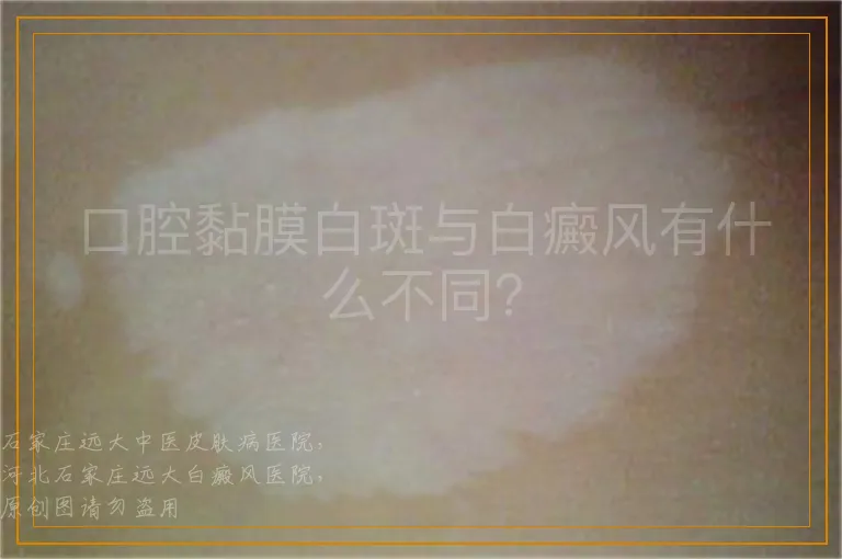 口腔黏膜白斑与白癜风有什么不同？