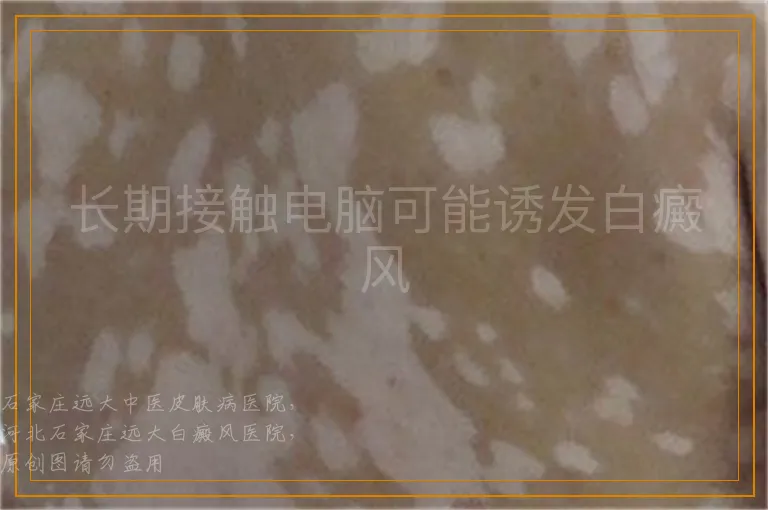 长期接触电脑可能诱发白癜风