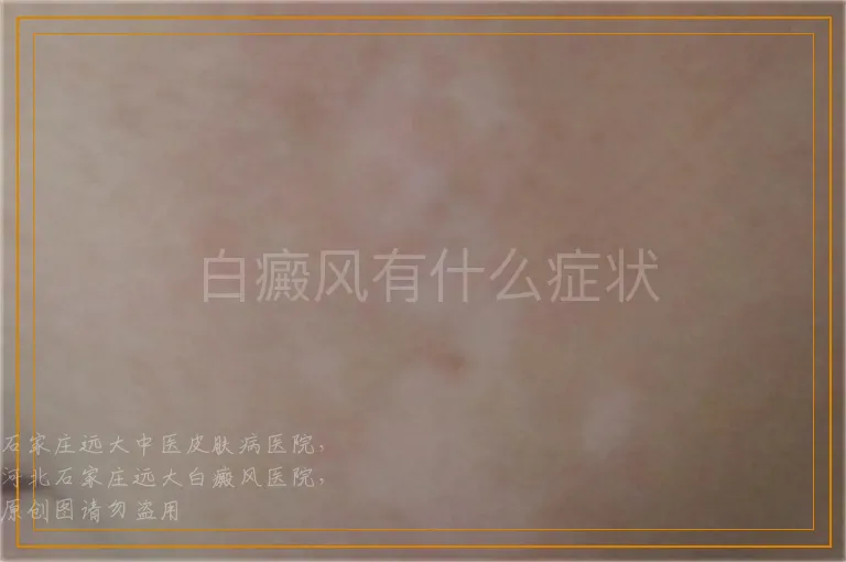 白癜风有什么症状