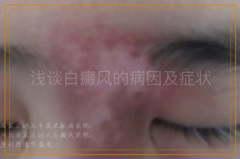 浅谈白癜风的病因及症状