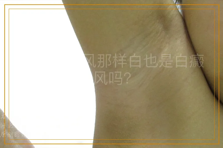 没有白癜风那样白也是白癜风吗？