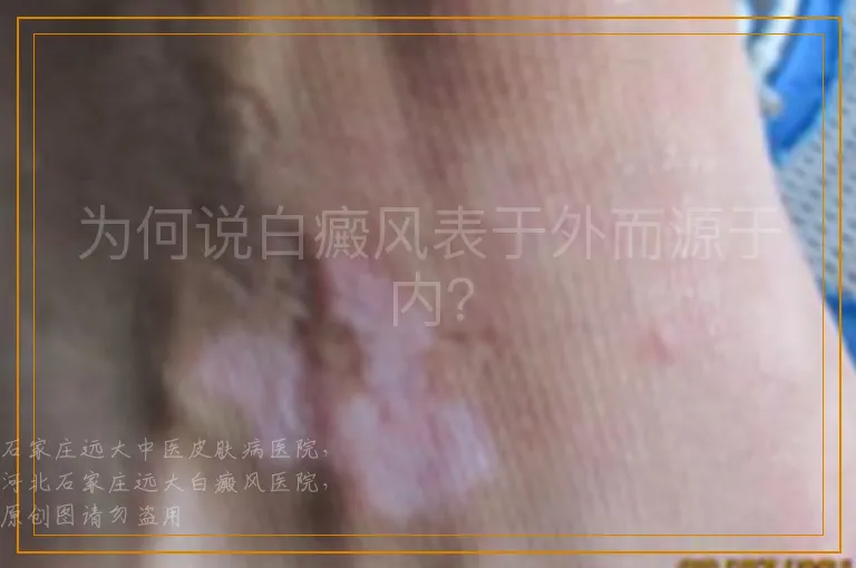 为何说白癜风表于外而源于内？