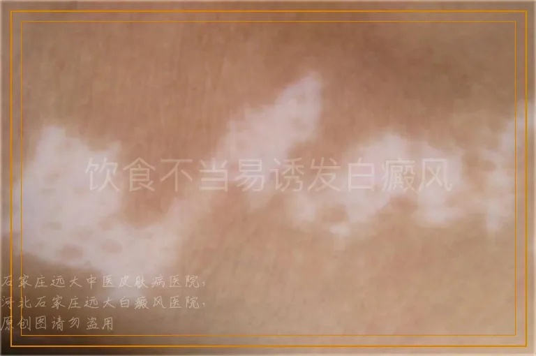 饮食不当易诱发白癜风