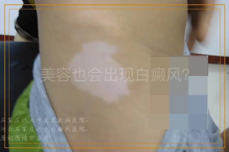 美容也会出现白癜风？
