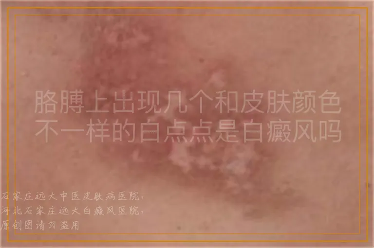 胳膊上出现几个和皮肤颜色不一样的白点点是白癜风吗？