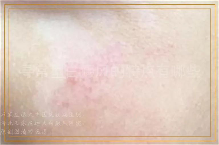 寻常型白癜风的特点有哪些