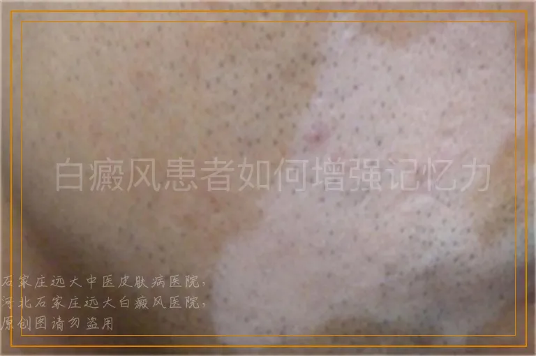 白癜风患者如何增强记忆力
