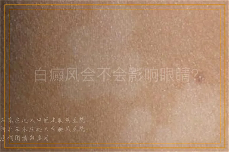 白癜风会不会影响眼睛？