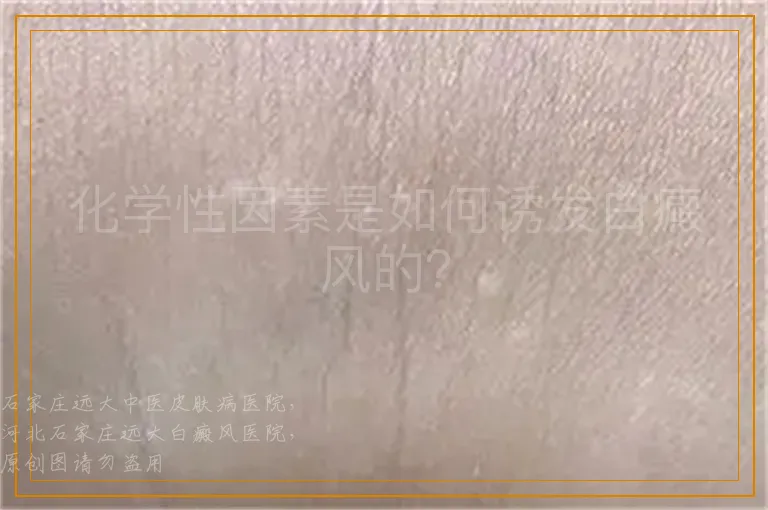 化学性因素是如何诱发白癜风的？